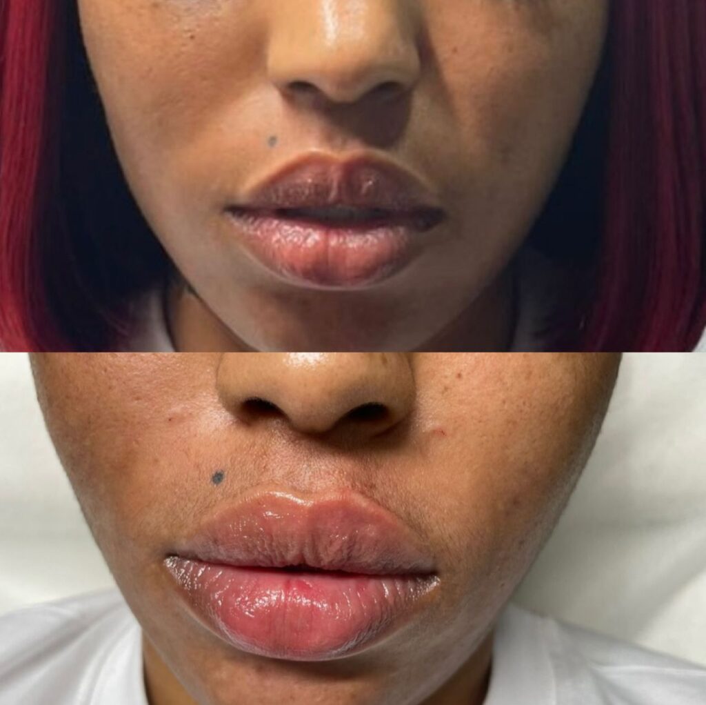 Botox, fillers, skin, chemical peels, rejuvenation, weight loss, flat tummy, butt hips fillers, dark spots, acne, hyperpigmentation, wrinkles, slim face, even skin, lightening, brightening and whitening