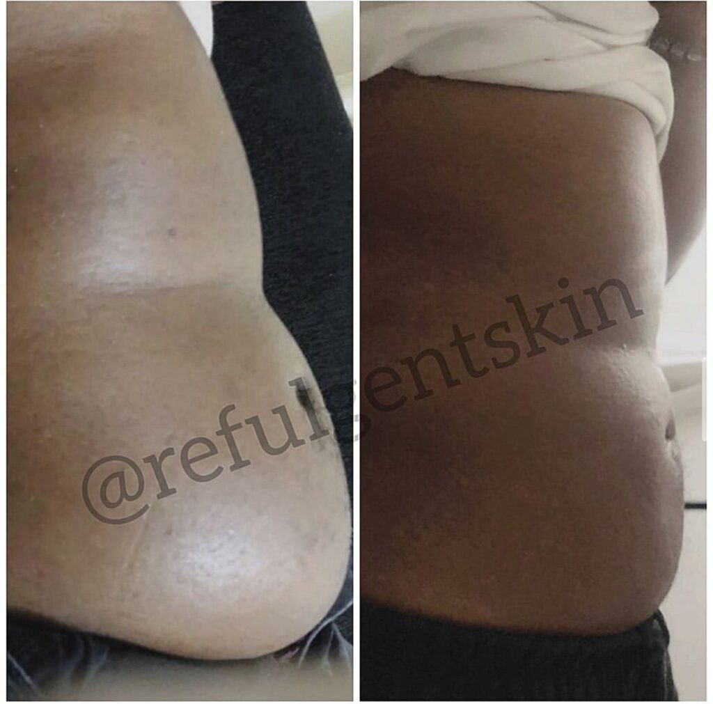 Botox, fillers, skin, chemical peels, rejuvenation, weight loss, flat tummy, butt hips fillers, dark spots, acne, hyperpigmentation, wrinkles, slim face, even skin, lightening, brightening and whitening